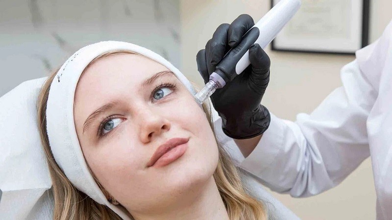 Unlocking the Benefits of the Microneedling Pen for Radiant Skin
